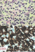 Cutaneous T-cell_lymphoma
