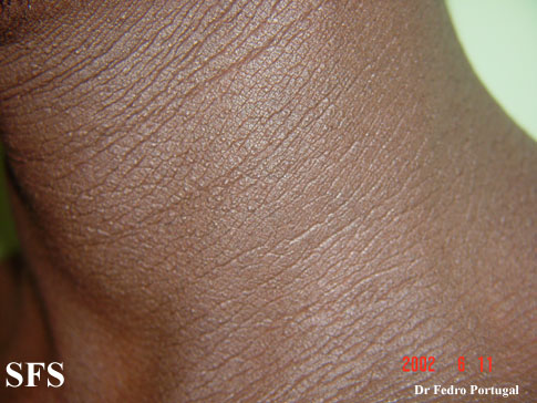 Acanthosis Nigricans