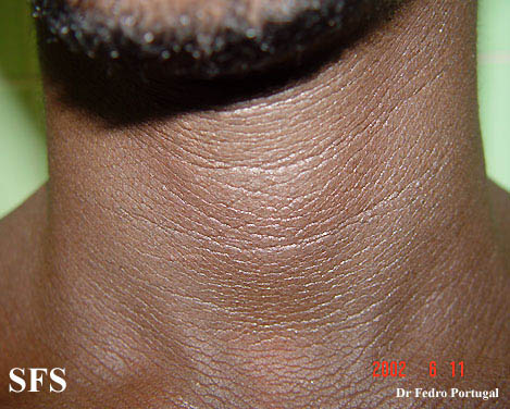 Acanthosis Nigricans in Dogs Blackening Skin VetInfo