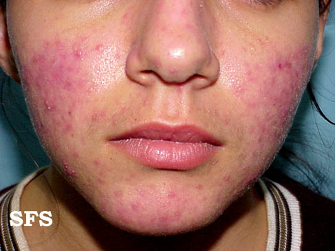 Facial rash and chest pain