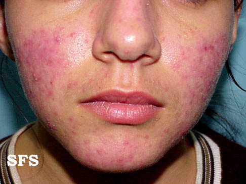 rash chest Facial pain and