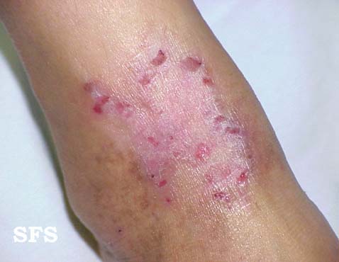 Atopic_Dermatitis2.JPG