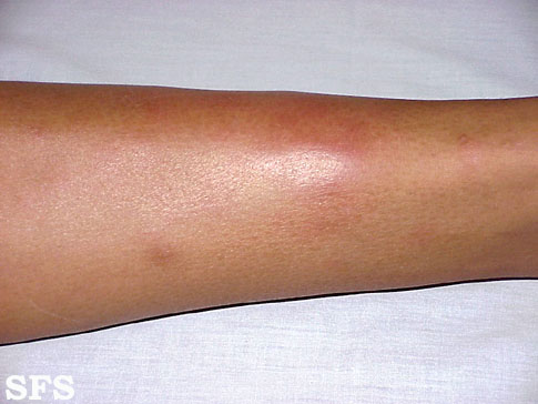  erythema nodosum