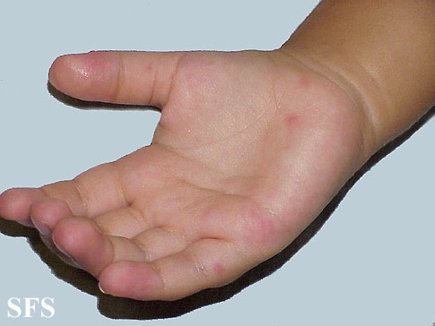 Images with the same Diagnosis from Dermatology Atlas Images with the same Diagnosis from Dermatology Atlas