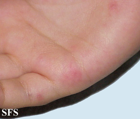 Images with the same Diagnosis from Dermatology Atlas Images with the same Diagnosis from Dermatology Atlas