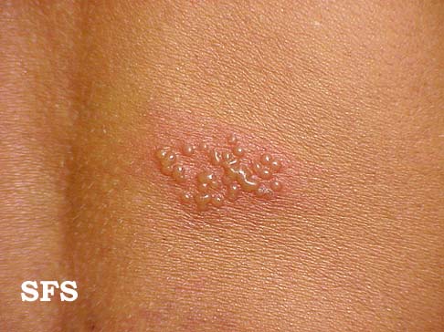 herpes simplex. Images with the same Diagnosis