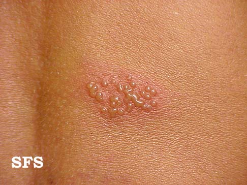 herpes simplex. Images with the same Diagnosis