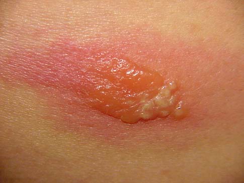 red bump - Herpes - MedHelp