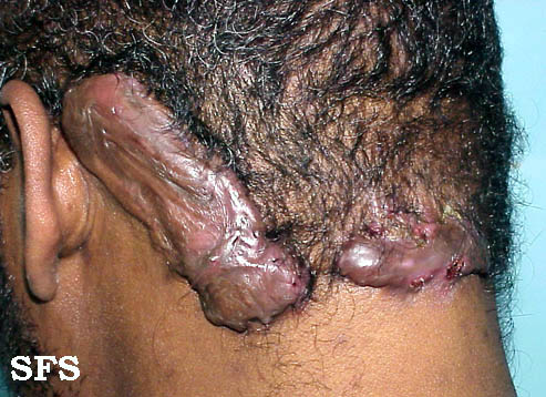 Pseudofolliculitis+nuchae