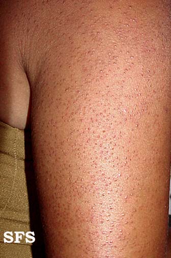 Keratosis pilaris Overview - Mayo Clinic