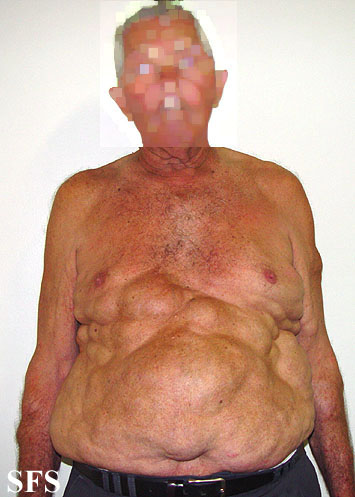Multiple Symmetric Lipomatosis