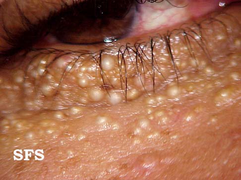 Eyes Face Lips on Those Pesky Little White Spots     Tackling Milia    Because Beauty Is