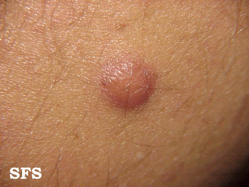 Dermnet: Dermatology Pictures - Skin Disease Pictures