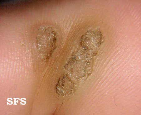plantar wart. (wart, plantar