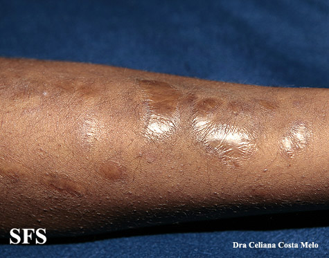 ehlersdanlos syndrome. Ehlers Danlos Syndrome