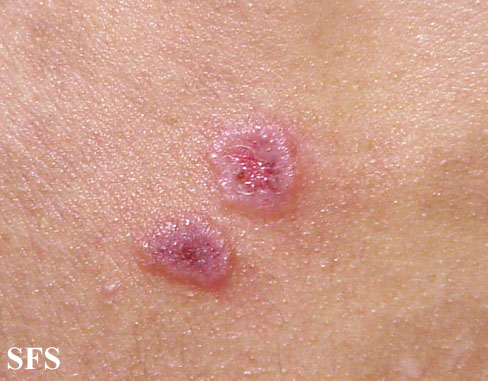 eosinophilic folliculitis #10