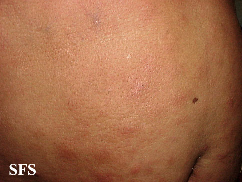 Lepromatous Leprosy Pictures. Leonine+facies+leprosy