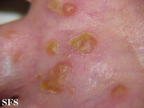 Reiter's Syndrome26 Reiter's Syndrome26
