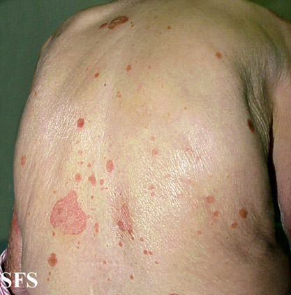 Reiter's Syndrome34 Reiter's Syndrome34