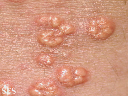 Cholesterol+deposits+eyelid