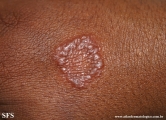 leprosy tuberculoid