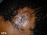 syringolymphoid hyperplasia with alopecia