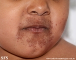 childhood granulomatous periorificial dermatites