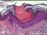 porokeratosis-segmental porokeratosis