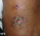 factitial dermatitis