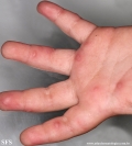 hand-food-and-mouth disease
