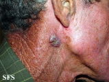 squamous cell carcinoma