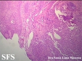 langerhans cell histiocytosis