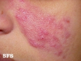 acne rosacea