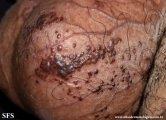 angiokeratoma of the scrotum