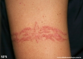 henna tattooing dermatitis