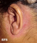 seborrhoeic dermatitis