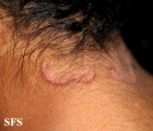 seborrhoeic dermatitis