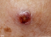 merkel cell tumours