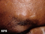 lymphocytic infiltration of the skin
