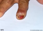 carpal syndrome -painful ulcer on finge