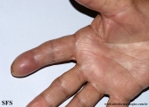 carpal syndrome -painful ulcer on finge