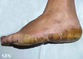 tylotic dermatitis