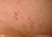 pruritic urticarial papules and plaques of pregnancy