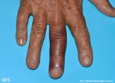 paroxysmal finger haematoma