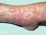 allergic vasculitis