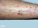 allergic vasculitis(allergic_vasculitis2.jpg)