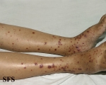 allergic vasculitis(allergic_vasculitis8.jpg)