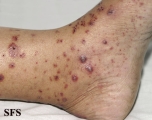 allergic vasculitis(allergic_vasculitis11.jpg)
