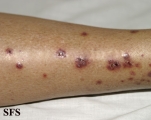allergic vasculitis(allergic_vasculitis12.jpg)
