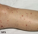 allergic vasculitis(allergic_vasculitis13.jpg)